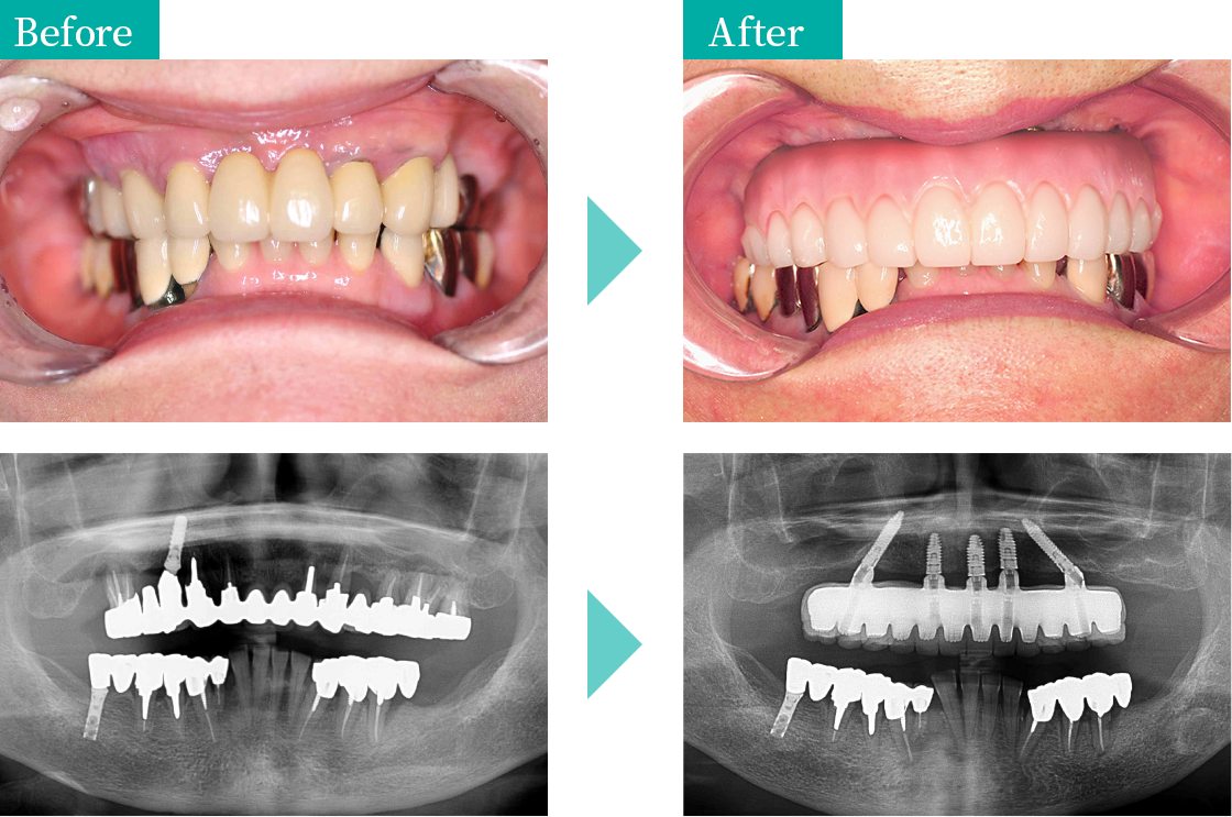 当院でオールオンＸを行いました　治療例① Before After