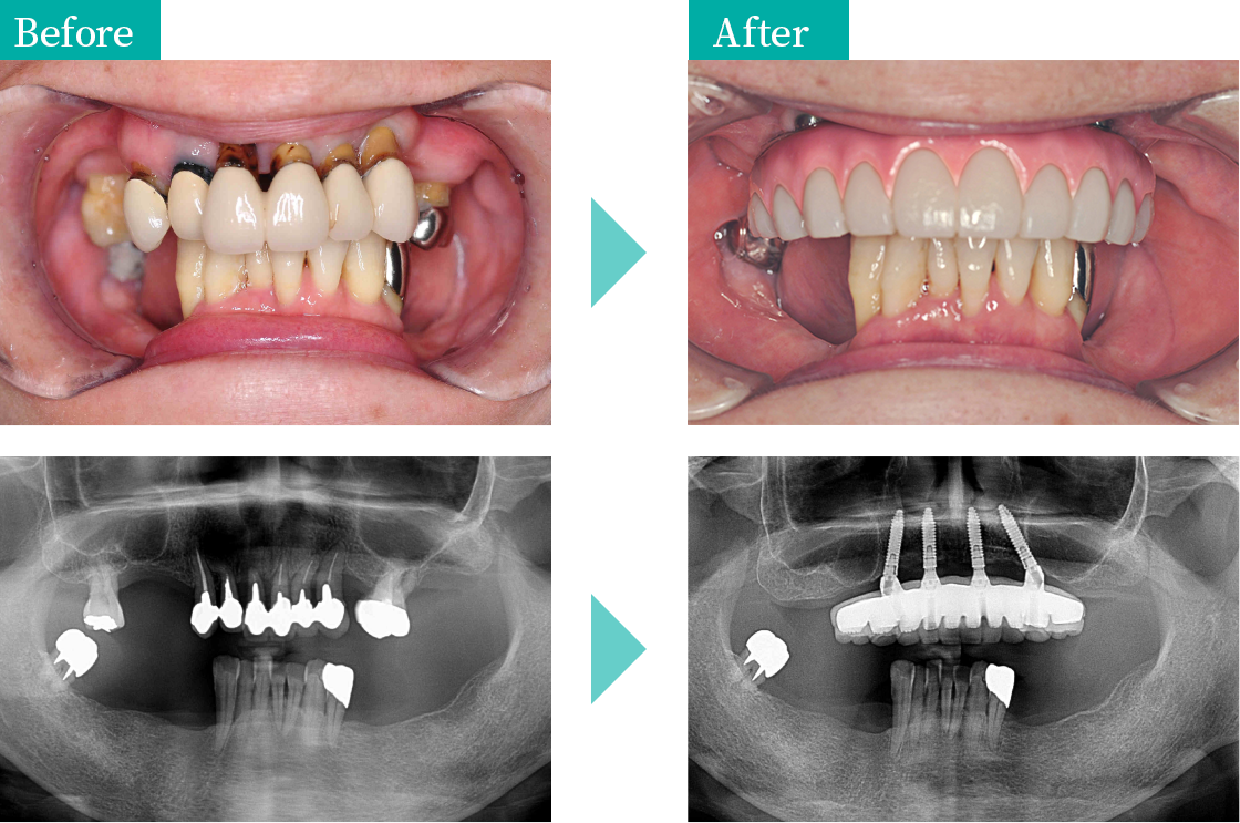 当院でオールオンＸを行いました　治療例② Before After 