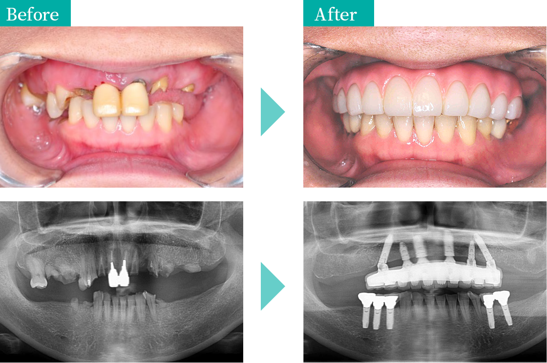 当院でオールオンＸを行いました　治療例③ Before After