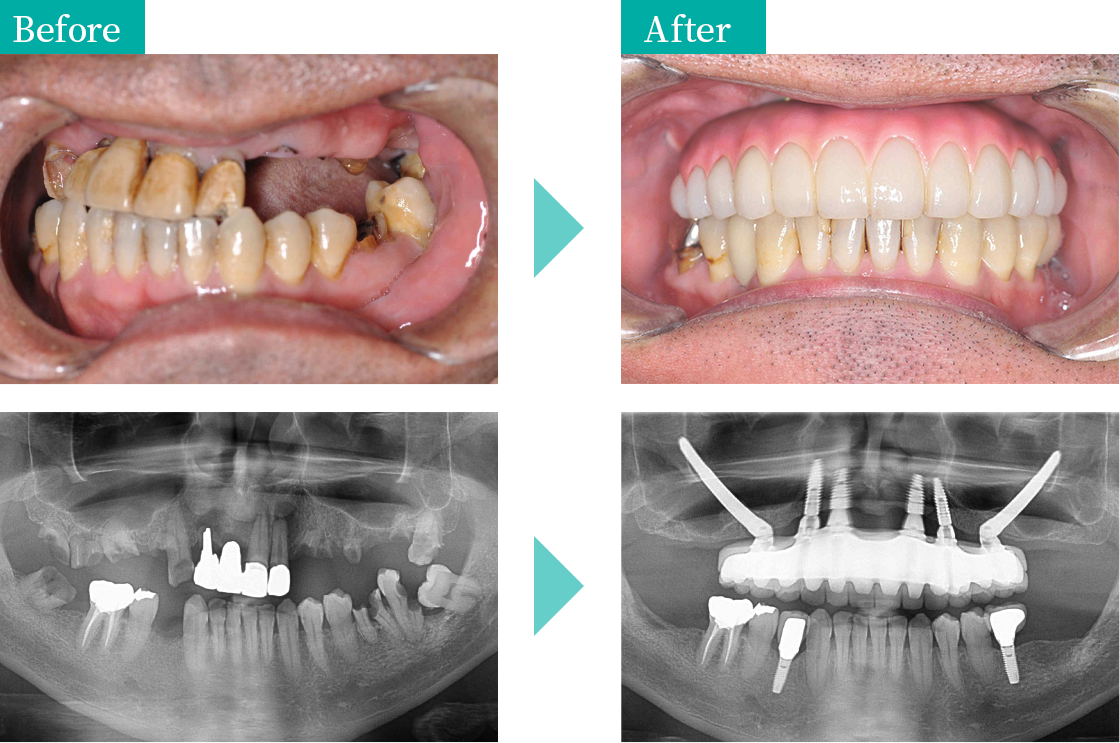 特殊なオールオンＸの症例　ザイゴマ インプラント Before After