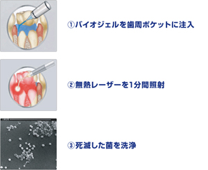 PDT治療の流れ