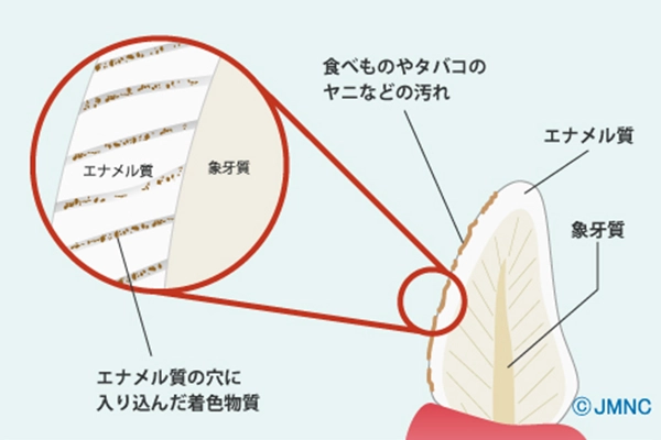 歯の汚れ